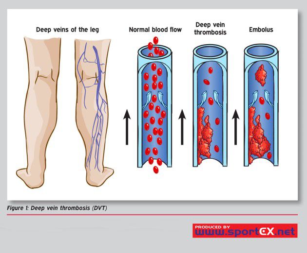 blood clots during travel