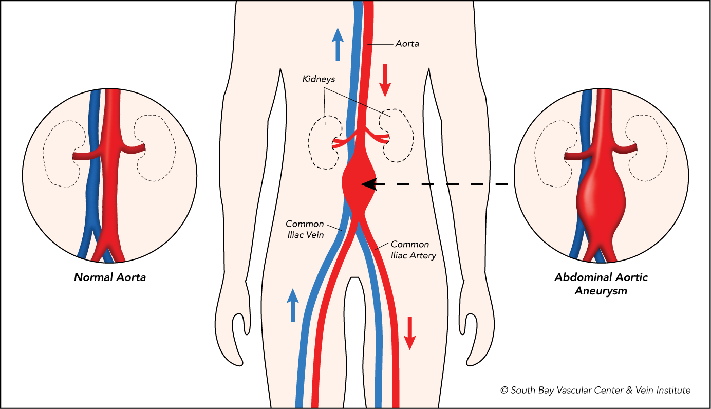 Aneurysms South Bay Vascular Center And Vein Institute