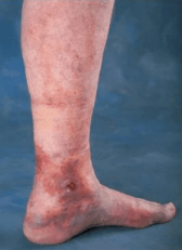 Non Healing Leg Wounds - South Bay Vascular Center and Vein Institute
